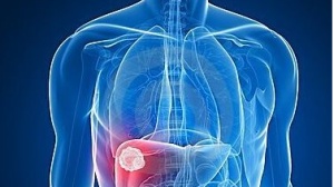 ASCO2016快讯丨PD-1肝癌临床数据解析：肿瘤消失后又发生了什么？