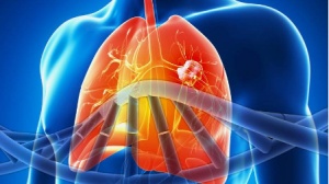 最佳胸部肿瘤论文丨PD-1单抗治疗晚期非小细胞肺癌（NSCLC）