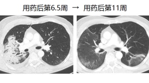 有惊无险：三次PD-1抗体，肿瘤消失14个月！