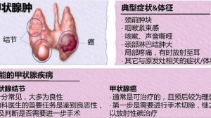 甲状腺结节：吓死了？怎么办？