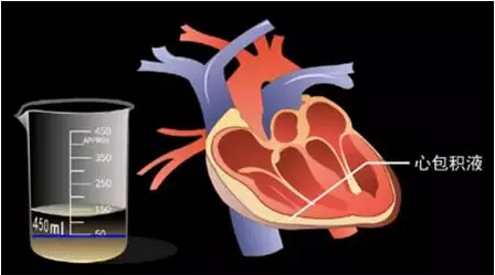 心包积液警惕