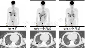 PD1用药后2周就能判断疗效？什么神器！