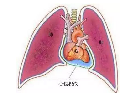 恶性心包积液是癌症患者常见的并发症之一,在肿瘤患