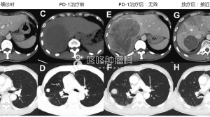 PD-1单用无效？加点放疗！