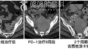 PD-1无效？化疗依然有效！