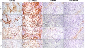 PD-L1动态检测，才能更好地预测PD-1疗效！