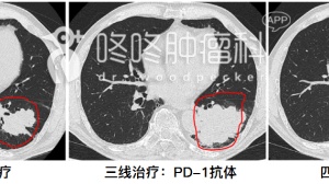 厉害了：PD-1还能增敏化疗？！