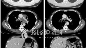 PD1，垂体炎，持久疗效：有失必有得