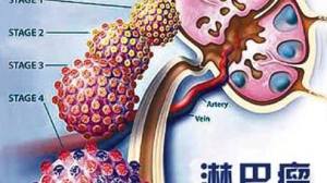 Pembrolizumab，治疗原发性纵膈B细胞淋巴瘤显奇功