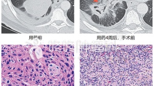 PD-1用于肺癌防复发，可能形成终身肿瘤免疫记忆！