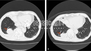 双原发肿瘤：PD-L1强阳和PD-L1阴性，用PD-1效果如何？