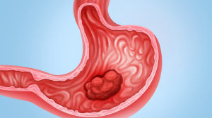 胃癌为什么要进行术前新辅助化疗，是否能从中获益及其利弊分析