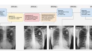双免疫治疗联合“高效且高毒”，这样使用副作用大幅降低
