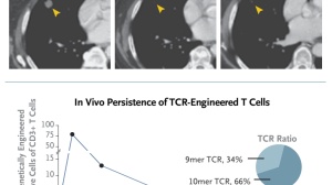 创造历史！“万癌之王”胰腺癌或将迎来药物克星：TCR-T免疫治疗新技术实现突破，患者肿瘤消退72%！