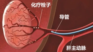 了解肝细胞癌（中）：HCC的局部治疗