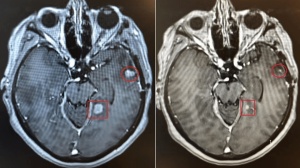 一针逆转癌症！跨时代的「神仙抗癌药」已经到来，临床试验正式开启！