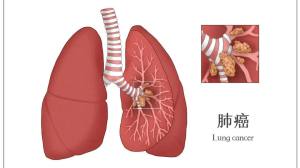 肺癌咯血躲不过？这有一份锦囊请收好！