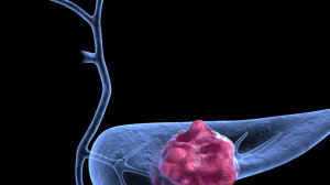 NEJM：Sotorasib治疗KRAS p.G12C基因突变胰腺癌最新进展