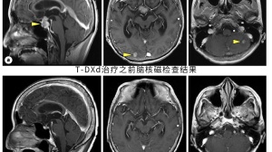 惊叹，神药DS-8201让脑转移的癌症患者盲目复明