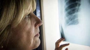 2023年世界肺癌大会公布两项肺癌治疗新成果