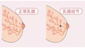 乳腺增生、结节究竟会不会癌变？3分钟教你看懂体检报告！